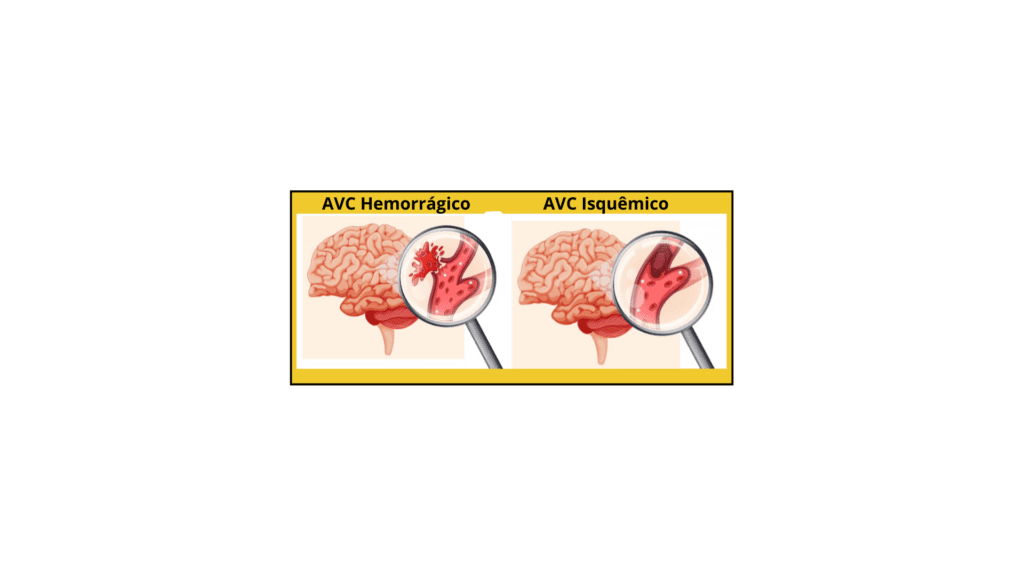 AVC-Isquemico-1024x576 Fisioterapia Após AVC: Recupere Movimento e Qualidade de Vida